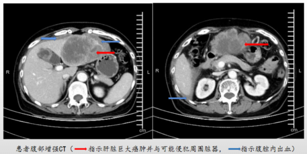 巨大肝癌破裂出血命懸一線,居然和十五年前肝炎有關係!醫生提醒:這些人群需要定期做篩查 巨大肝癌破裂出血命懸一線,居然和十五年前肝炎有關係!醫生提醒:這些人群需要定期做篩查