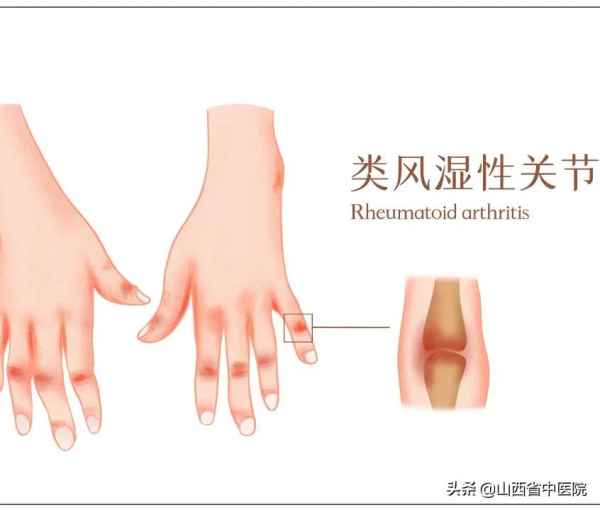 一變天就關節痛，風溼病該如何調理？這個方法或許能派上用場