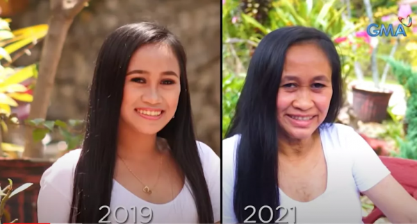 16歲菲律賓少女迅速衰老成60歲老人的臉,尋遍醫生後找出心酸病因 16歲菲律賓少女迅速衰老成60歲老人的臉,尋遍醫生後找出心酸病因