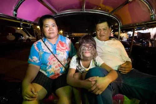 泰國女孩臉上長滿毛髮，長相特殊受盡嘲諷，父母卻視她為掌上明珠