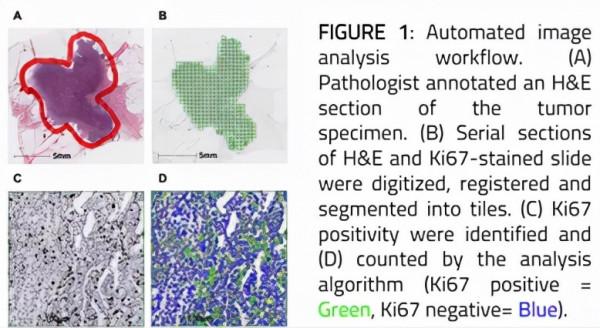 李南林教授：早期HR+乳腺癌輔助強化人群篩選高危因素Ki-67的思考