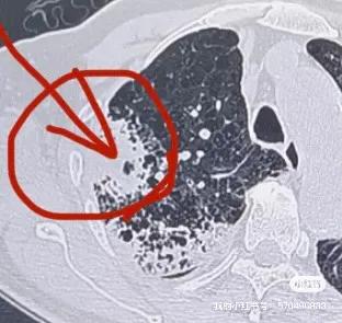 氬氦刀冷凍活檢隨訪篇
