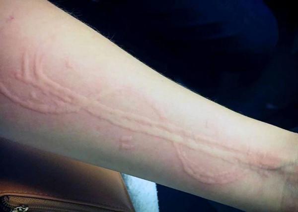 面板瘙癢難耐，反覆發作，做這5種檢查可精準判斷