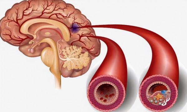 為何我國腦梗發病率居高不下?醫生提醒:預防腦梗,需注意3點 為何我國腦梗發病率居高不下?醫生提醒:預防腦梗,需注意3點