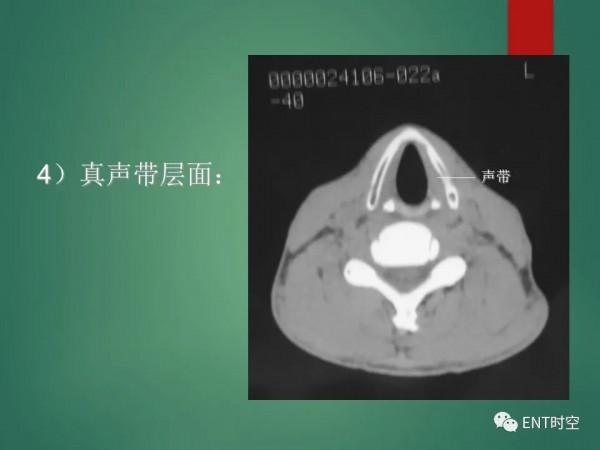 頭頸五官CT斷層解剖圖及常見病影像診斷