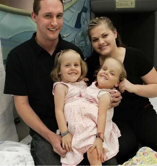 雙胞胎女嬰腹部相連醫生都說活不了，4歲做分離手術如今已滿20歲