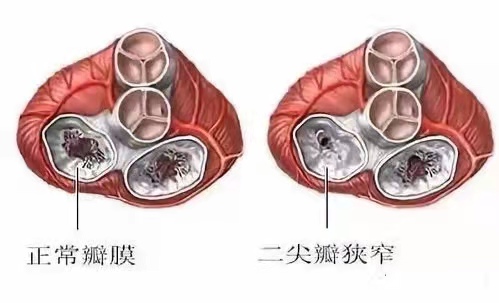 二尖瓣狹窄
