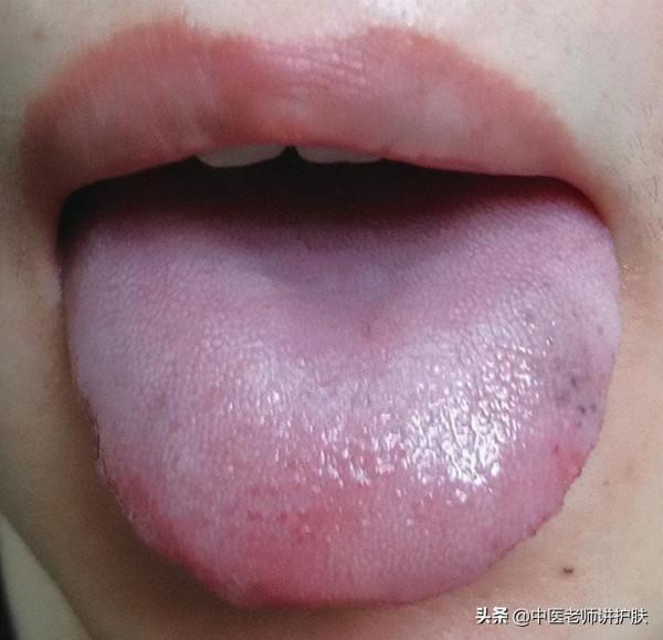 黃褐斑治療一年無果還加重，巧用中藥湯劑，月餘時間斑塊明顯減少