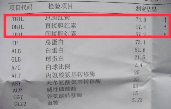 肝功能單純膽紅素升高,吃了很多藥都沒有效果?醫生給你分析病因 肝功能單純膽紅素升高,吃了很多藥都沒有效果?醫生給你分析病因