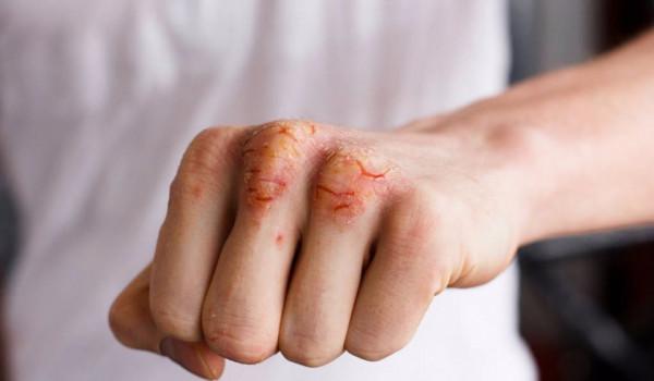 冬季手足紅斑乾裂 是溼疹還是凍瘡？1分鐘辨別，對症治療才有效