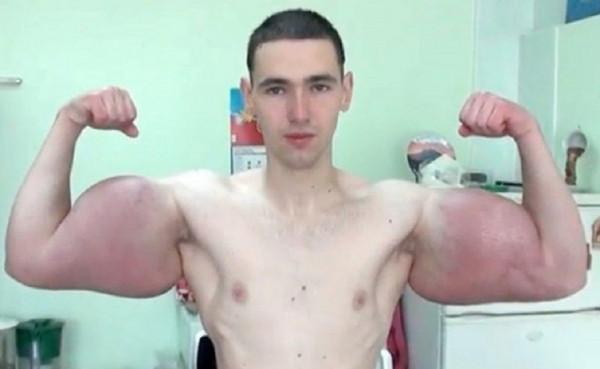 “俄羅斯大力水手”，61釐米手臂面臨手術，否則將有截肢風險