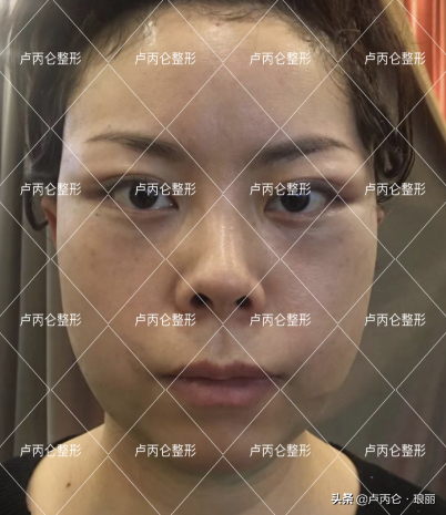 拉皮術後可能會出現哪些問題?術後有哪些後遺症 拉皮術後可能會出現哪些問題?術後有哪些後遺症