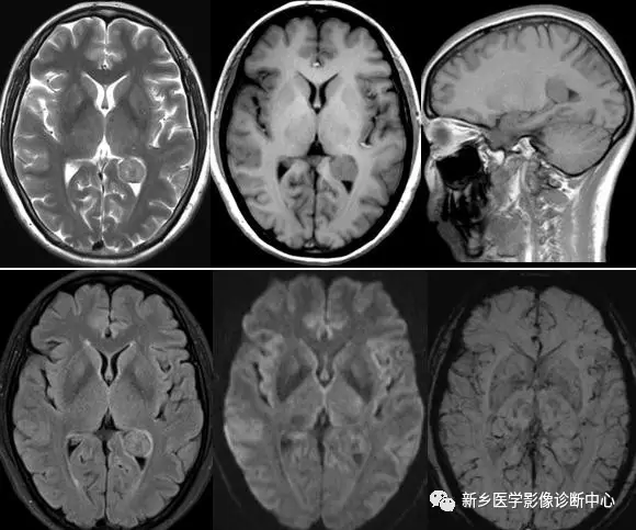在側腦室三角區看到佔位，要想到這8種腫瘤