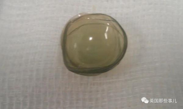 67歲老人做手術從眼中取出27片隱形眼鏡,醫生還以為是白內障 67歲老人做手術從眼中取出27片隱形眼鏡,醫生還以為是白內障