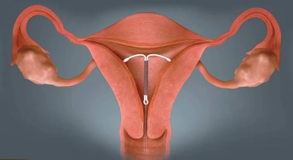 “殘害一代中國女性”的節育環,今日我想為它說上幾句公道話 “殘害一代中國女性”的節育環,今日我想為它說上幾句公道話