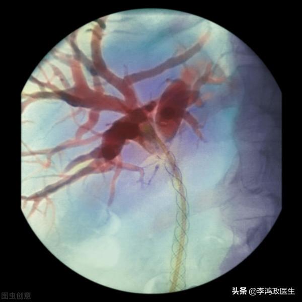 男子腹痛、面板黃，診斷膽管癌，妻子賣了房子治療後醫生：誤診了