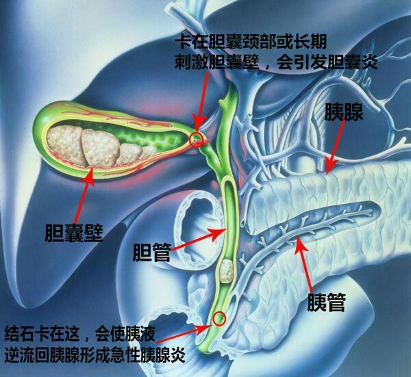 男子腹痛難耐危及生命，竟是膽結石惹的禍，你還覺得這是小病嗎？