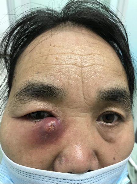 無故流淚眼睛腫成“鴿子蛋”專家提醒謹防急性淚囊炎