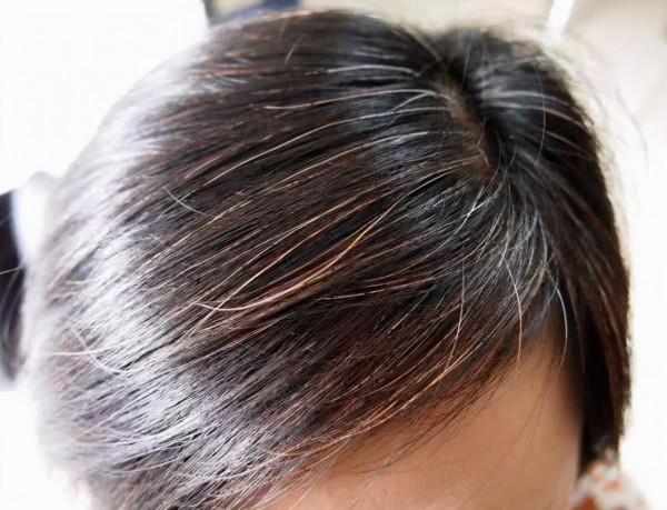 為啥白頭髮越長越多?你認為是老了,醫生:或是缺乏2種營養素 為啥白頭髮越長越多?你認為是老了,醫生:或是缺乏2種營養素