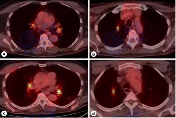 關注罕見癌種：血管肉瘤患者的治療