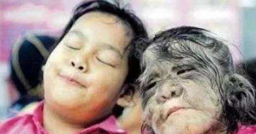 泰國女孩臉上長滿毛髮，長相特殊受盡嘲諷，父母卻視她為掌上明珠