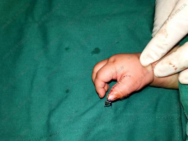 多指手術幾個月後,孩子哭個不停,媽媽扳開寶寶手後立馬送進醫院 多指手術幾個月後,孩子哭個不停,媽媽扳開寶寶手後立馬送進醫院