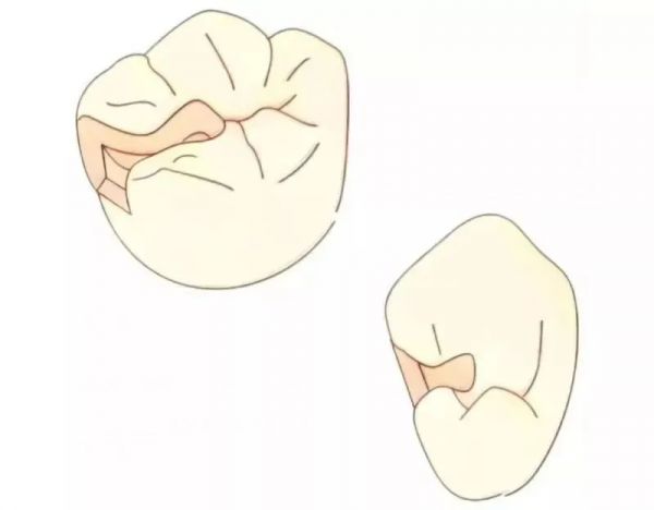 想要補個牙,反而被磨了個大洞? 想要補個牙,反而被磨了個大洞?