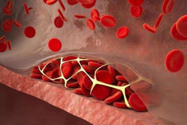 兩種中成藥，多靶點“清理血液”，從根上疏通冠脈，改善心肌缺血