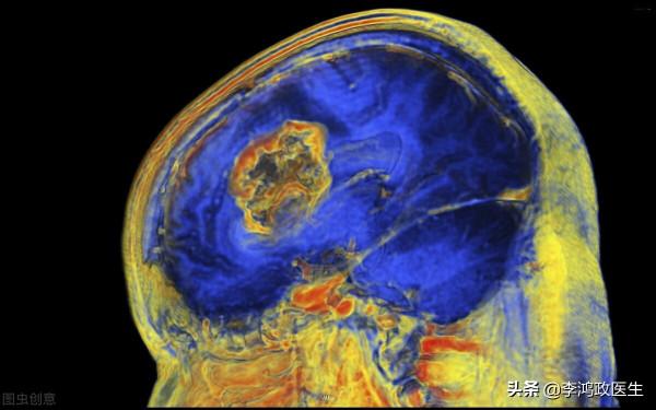 女子頭痛，經常聞到臭水溝味道，直到突然昏迷才發現腦袋長了個瘤