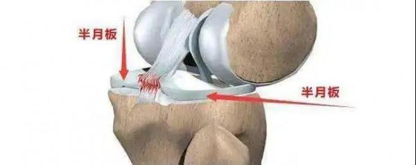 避免&OpenCurlyDoubleQuote;半月板&rdquo;損傷，要注意這幾點&srarr;