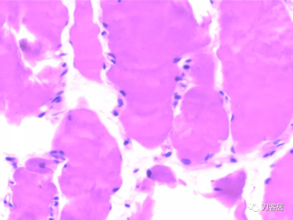 惡性高熱第3例：12歲，脊柱側彎，矯形術後死亡