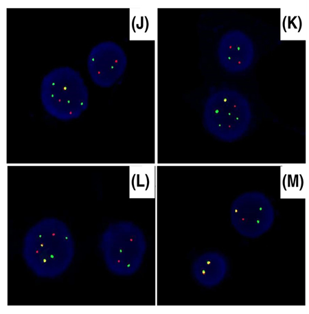 蘇州大學附屬第一醫院黃海雯教授:應用R2-CHOP方案有效治療罕見的四打擊多形性套細胞淋巴瘤的病例報告 蘇州大學附屬第一醫院黃海雯教授:應用R2-CHOP方案有效治療罕見的四打擊多形性套細胞淋巴瘤的病例報告