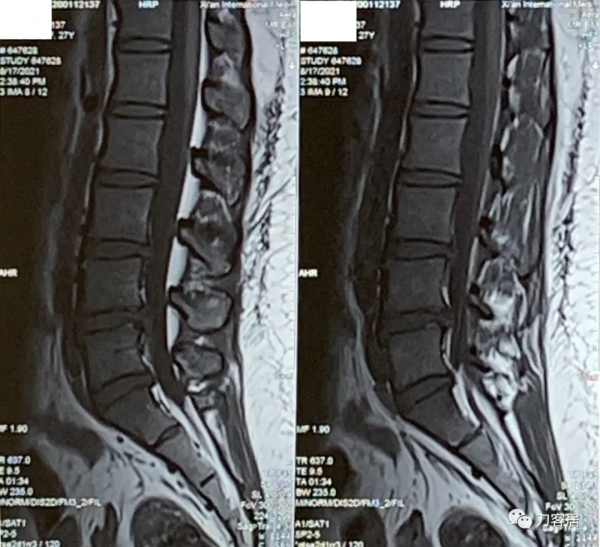27歲女性，兩間隙腰椎間盤突出症，6顆釘子，4個融合器
