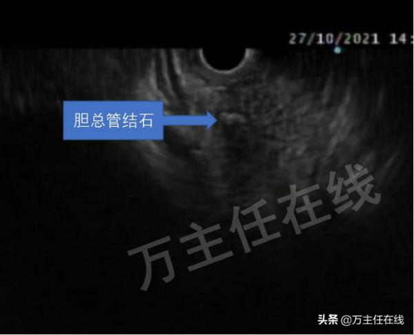 孕34周腹痛入院，多科通力合作挽救膽管結石伴膽管炎妊娠晚期孕婦