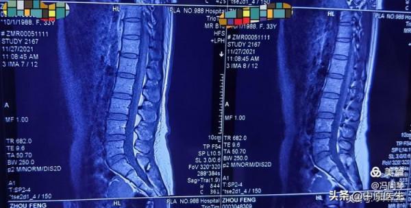 30歲女子右下肢麻木,多次治療無效,被細心老專家查出原因 30歲女子右下肢麻木,多次治療無效,被細心老專家查出原因