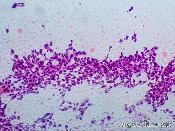 METex14突變晚期肺癌靶向藥Tepotinib(特泊替尼)獲CHMP積極意見