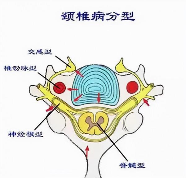 讓手機摧殘頸椎的年輕人，別讓“頸椎病”拖垮你，快來看這裡