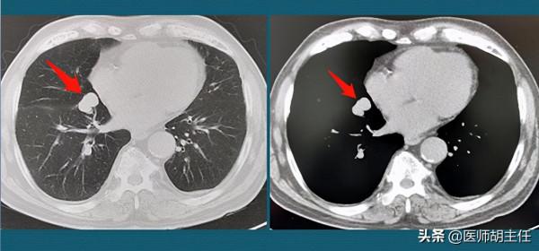 陳女士肺結節縮小了，醫生卻說是癌症，為啥肺結節縮小了還是癌症