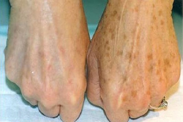 老年斑的誘發因素有哪些？為什麼有的人老了以後，不長老年斑？