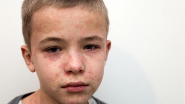 孩子身上出現紫紅色小點,可能是這個病,家長要注意 孩子身上出現紫紅色小點,可能是這個病,家長要注意