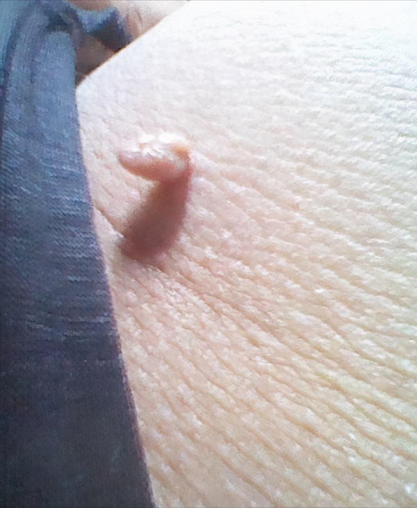 脖子上長了“小肉粒”，礙事嗎？要不要治療？醫生說明白了