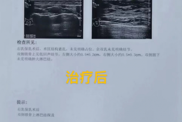 來自小梁的自述：乳腺癌毀掉了我的家庭