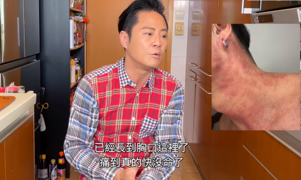 54歲蔡一傑健康出問題!患面板病一度疼痛難耐,脖子上佈滿紅斑 54歲蔡一傑健康出問題!患面板病一度疼痛難耐,脖子上佈滿紅斑