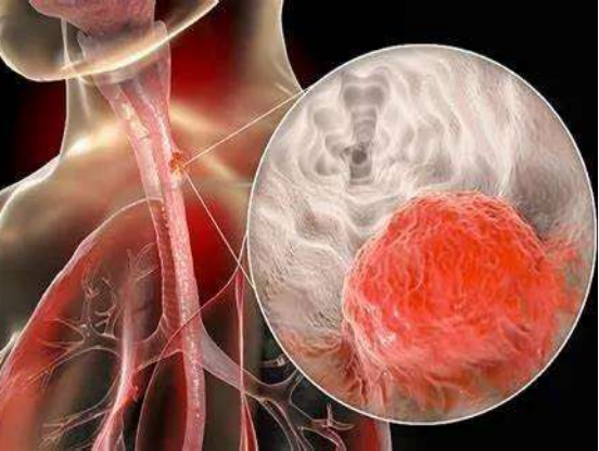 59歲男子咽喉乾燥、發癢，自以為&OpenCurlyDoubleQuote;咽炎&rdquo;，醫院檢查後男子崩潰了