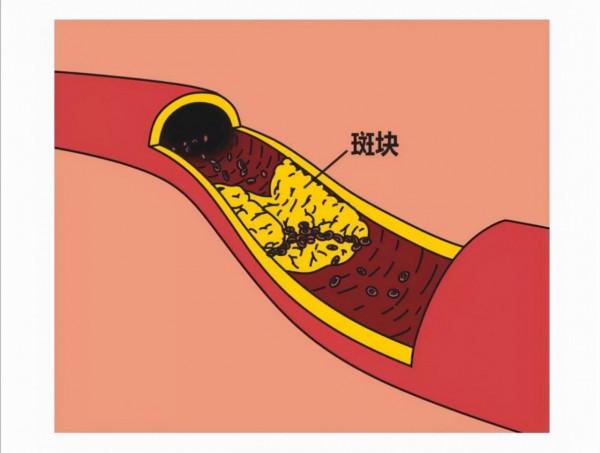 為什麼愛喝酒的人容易得腦梗死？醫生提醒：4大原因不容忽視