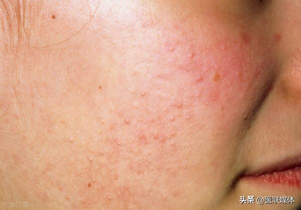 從頭髮上摳出“白泥”,是怎麼回事?與這3點有關 從頭髮上摳出“白泥”,是怎麼回事?與這3點有關