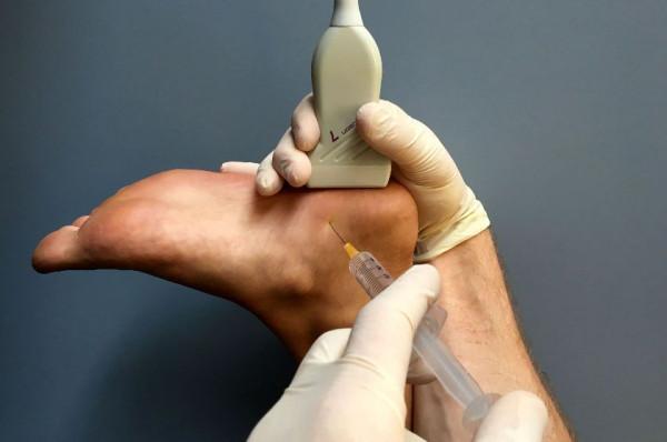 花椒水泡、踩酒瓶子、跺腳?這令人困擾的足跟痛,我們到底該咋辦 花椒水泡、踩酒瓶子、跺腳?這令人困擾的足跟痛,我們到底該咋辦