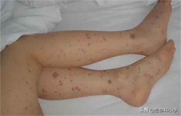 身上出現很多小紅點，不痛不癢是怎麼回事？聽聽醫生怎麼說