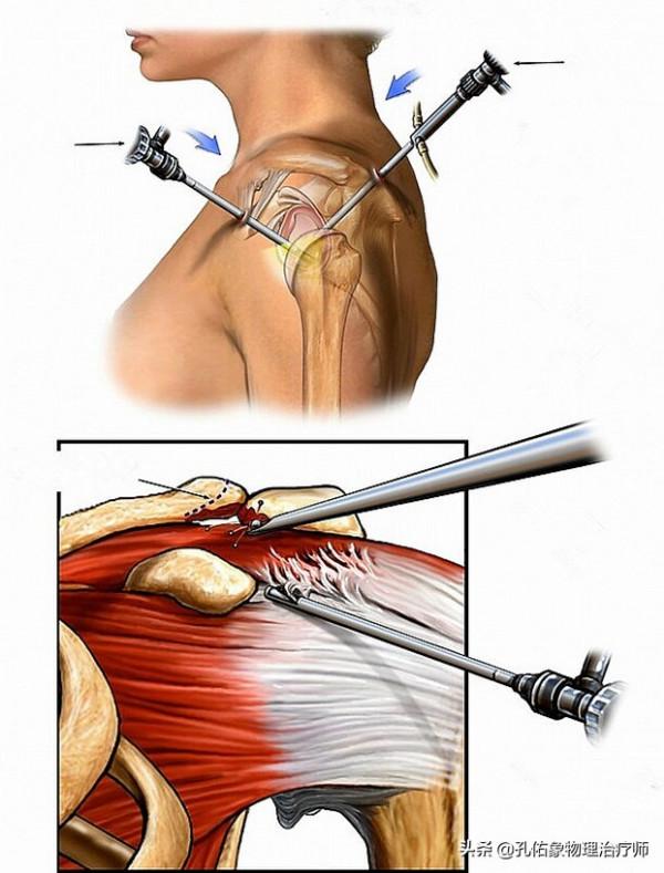 肩膀疼痛是咋回事？為啥不是肩周炎？本文告知您原因