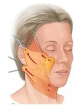 面部面板鬆弛下垂…很顯老怎麼辦？試試這個辦法